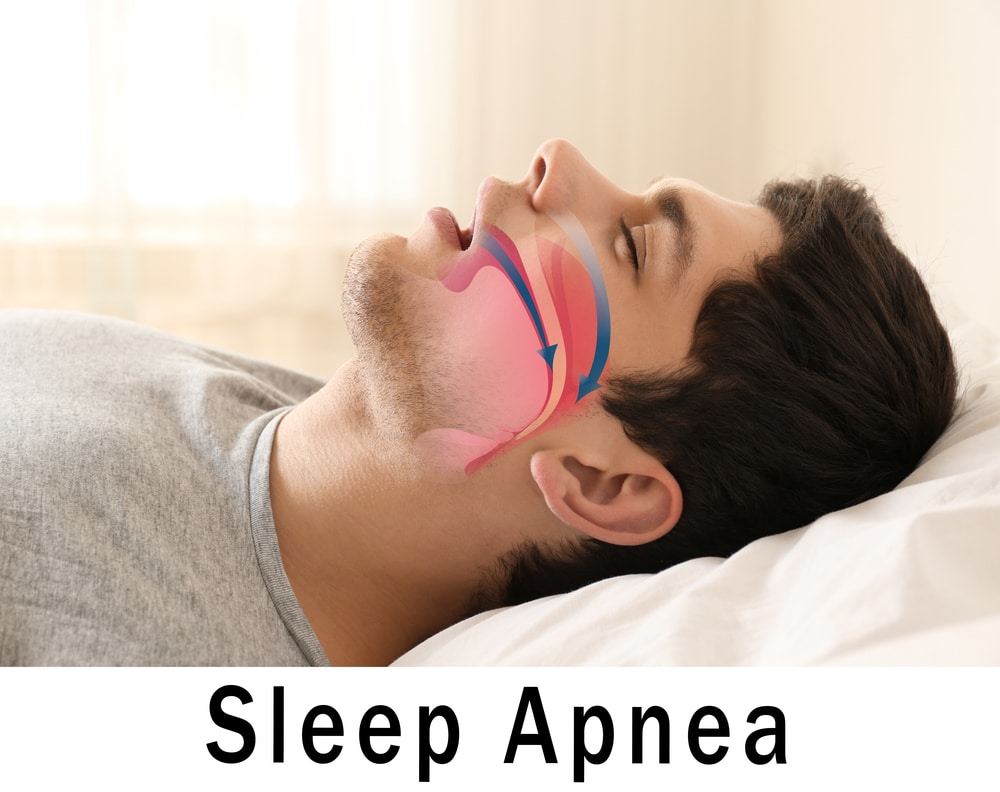 What Is Obstructive Sleep Apnea And How Do You Treat It von chan dds dentist in petaluma california