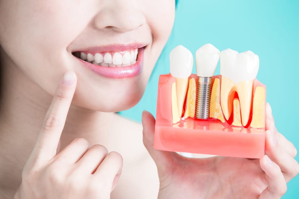 How Are Dental Implants Installed? von chan dds dentist in petaluma california
